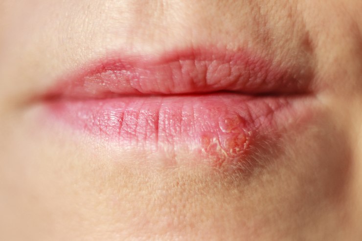 Herpes al labbro - Fonte AdobeStock