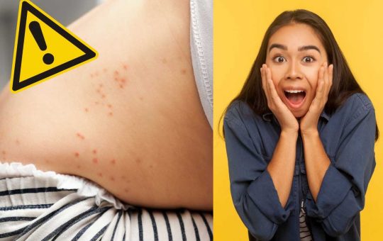 Epidemia di scarlattina - Fonte AdobeStock