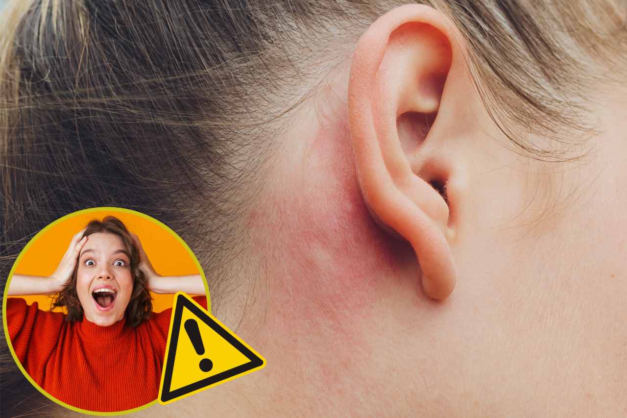 Psoriasi alle orecchie - Fonte AdobeStock