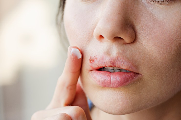 Trattamento dell'Herpes - Fonte AdobeStock