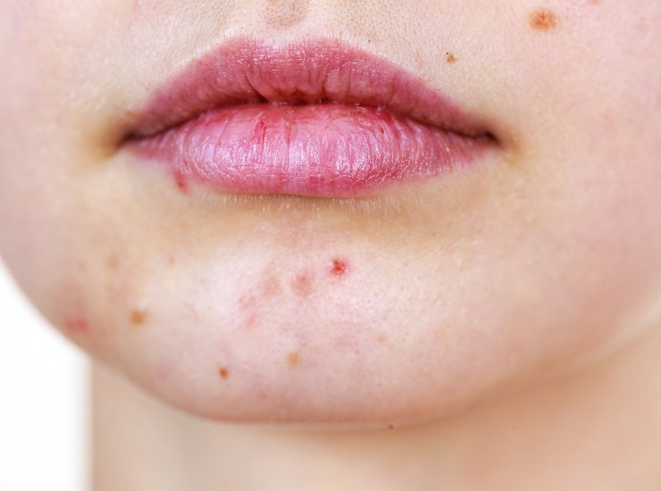 Acne sul viso - Fonte AdobeStock