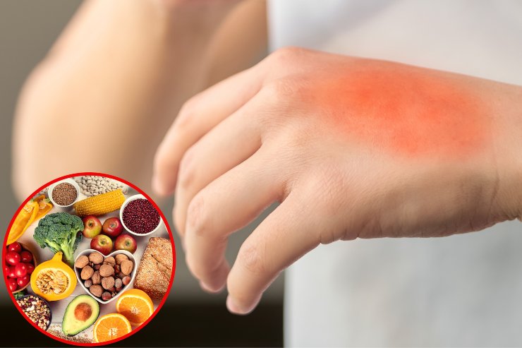 Allergie alimentari - Fonte AdobeStock