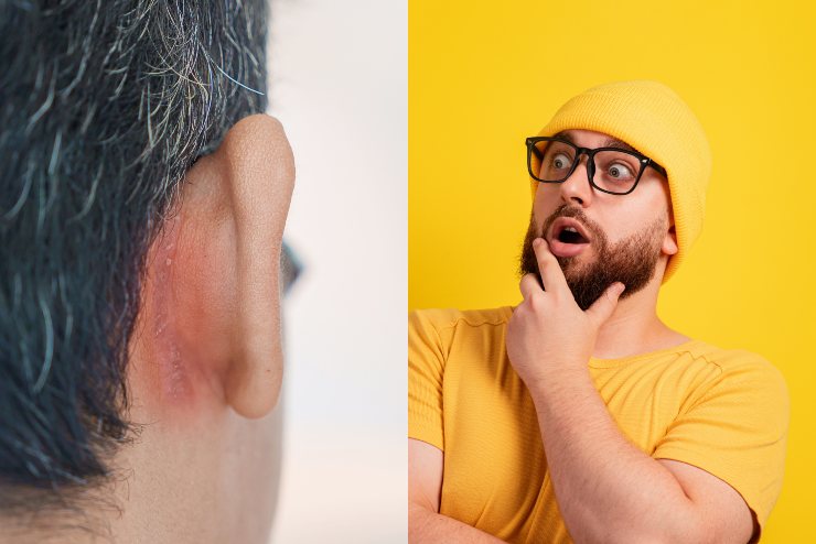 Dermatite seborroica nell'orecchio - Fonte AdobeStock