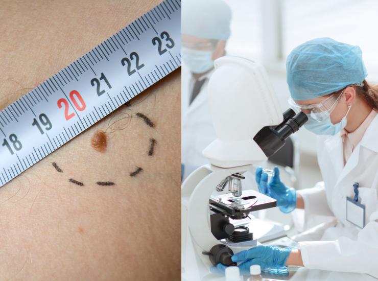 Importanti progressi sui melanomi - Fonte AdobeStock