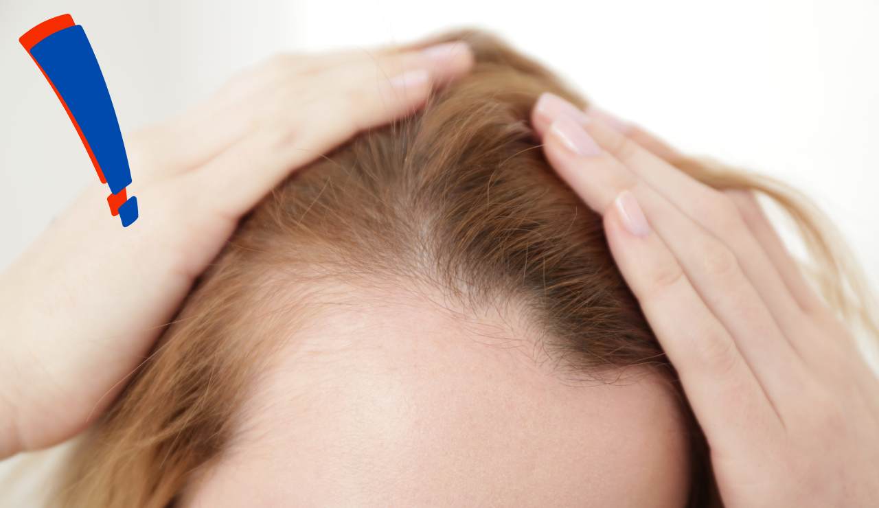 Star Disney affetta da alopecia - Fonte AdobeStock
