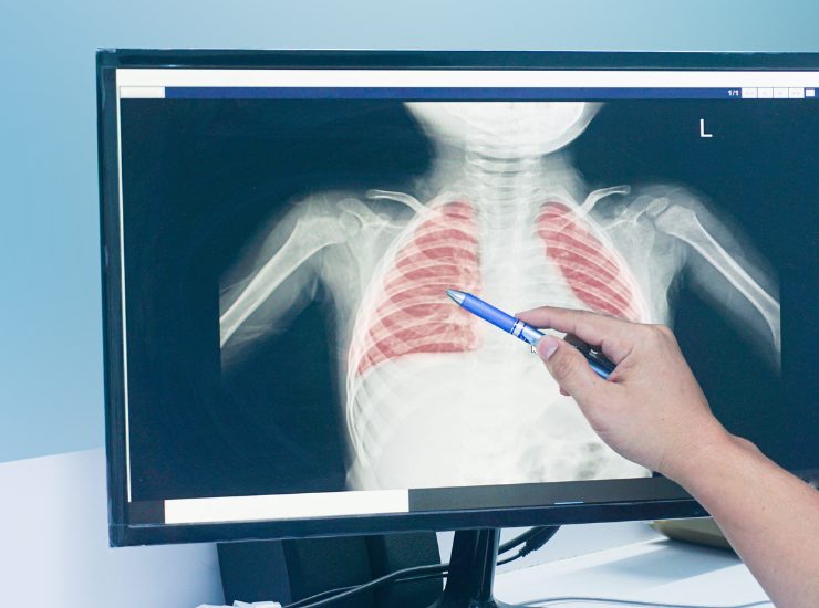 Tumore ai polmoni - Fonte AdobeStock