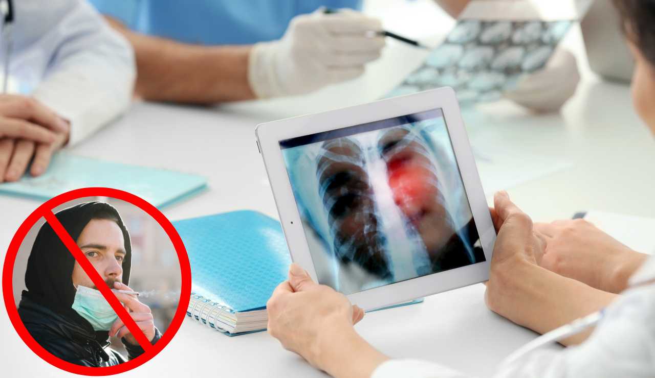 Tumore ai polmoni nei non fumatori - Fonte AdobeStock