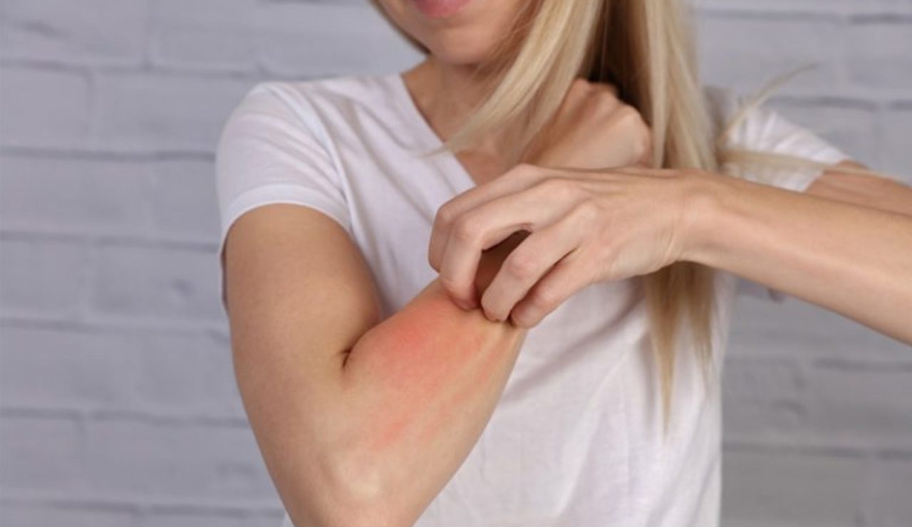 Orticaria da Stress