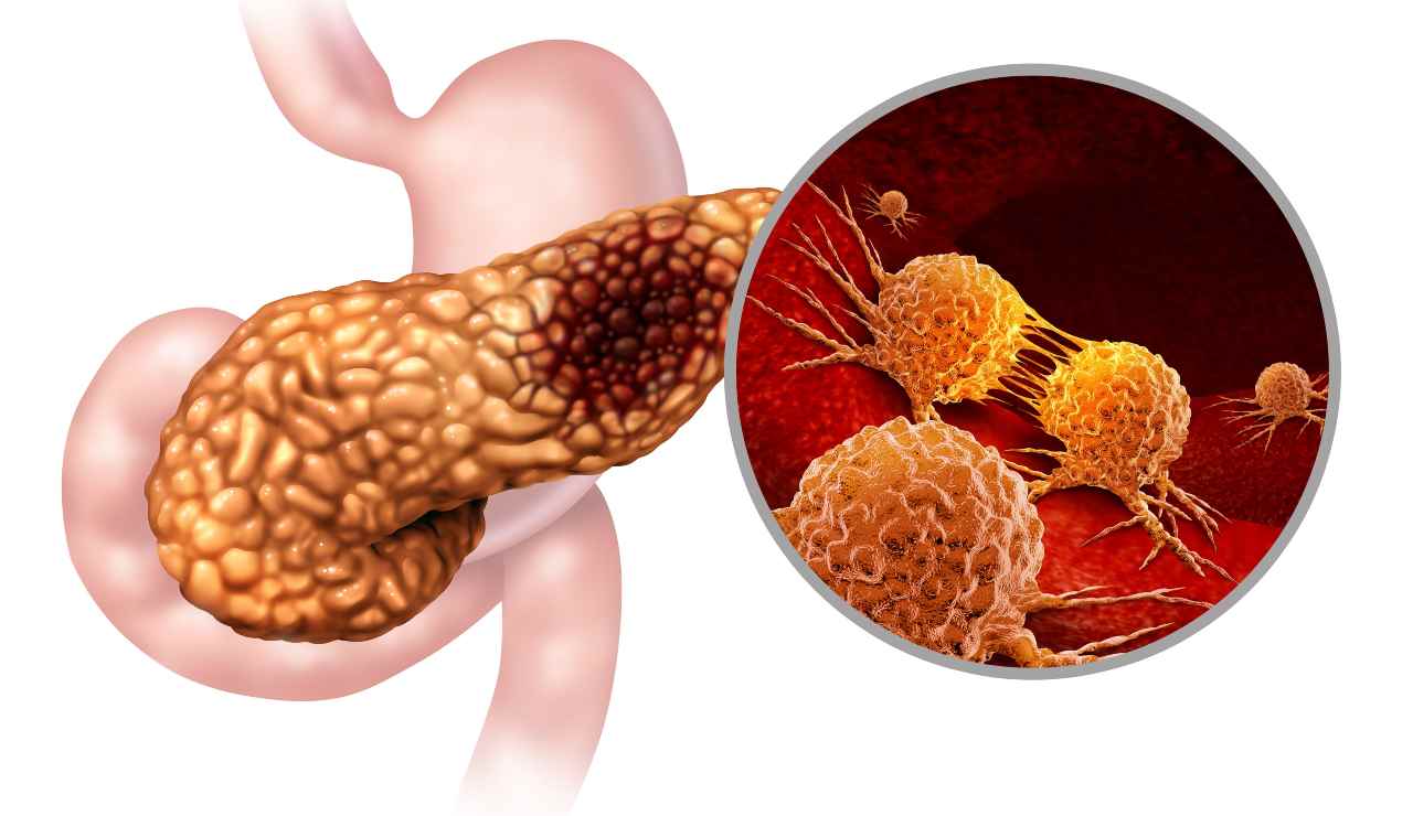 Tumore Pancreas