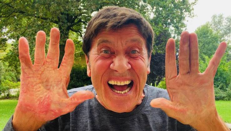 Gianni Morandi mostra le sue mani dopo l'incidente | Fonte; Screen da Iodonna