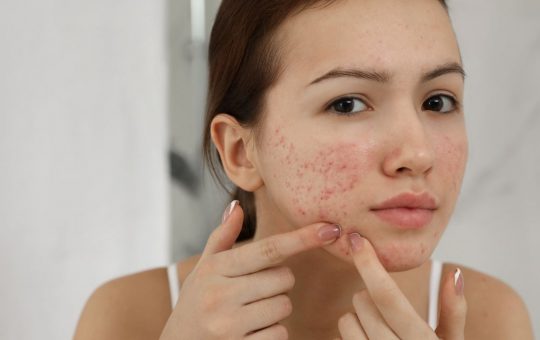 Acne e brufoli: cosa non fare | Fonte: Canva Newssalute.it