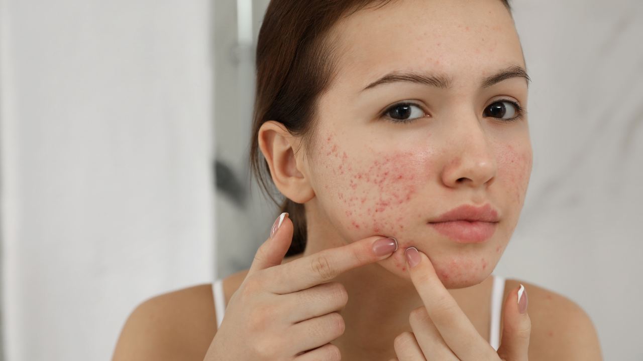 Acne e brufoli: cosa non fare | Fonte: Canva Newssalute.it