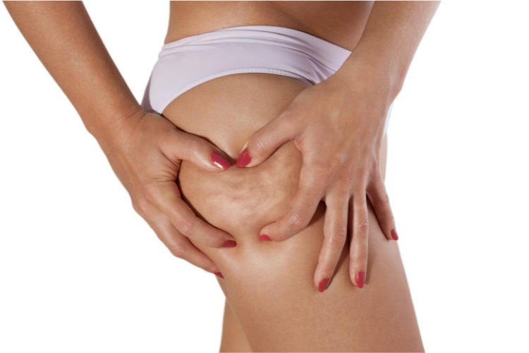 Cellulite, addio! | Fonte: Canva - Newssalute.it