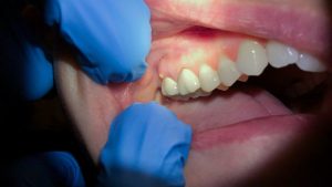 Ascesso dentale: cosa è | Fonte: Canva