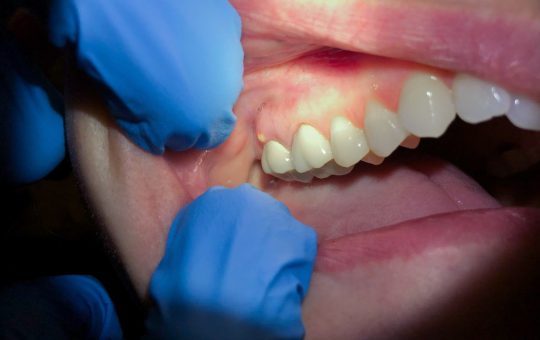 Ascesso dentale: cosa è | Fonte: Canva